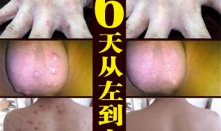 治疗疥疮最好的药膏 治疗疥疮最好的药膏